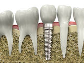 Implant Implant