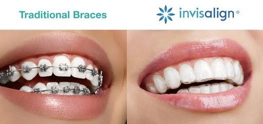 Traitement Invisalign